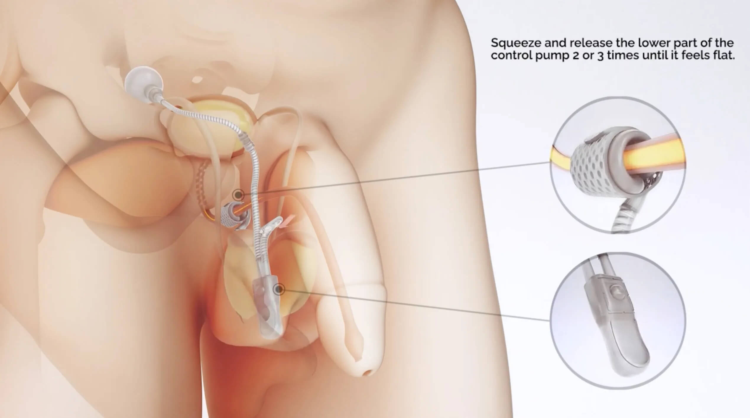 How to use your ContiClassic<sup>®</sup> Artificial Urinary Sphincter?