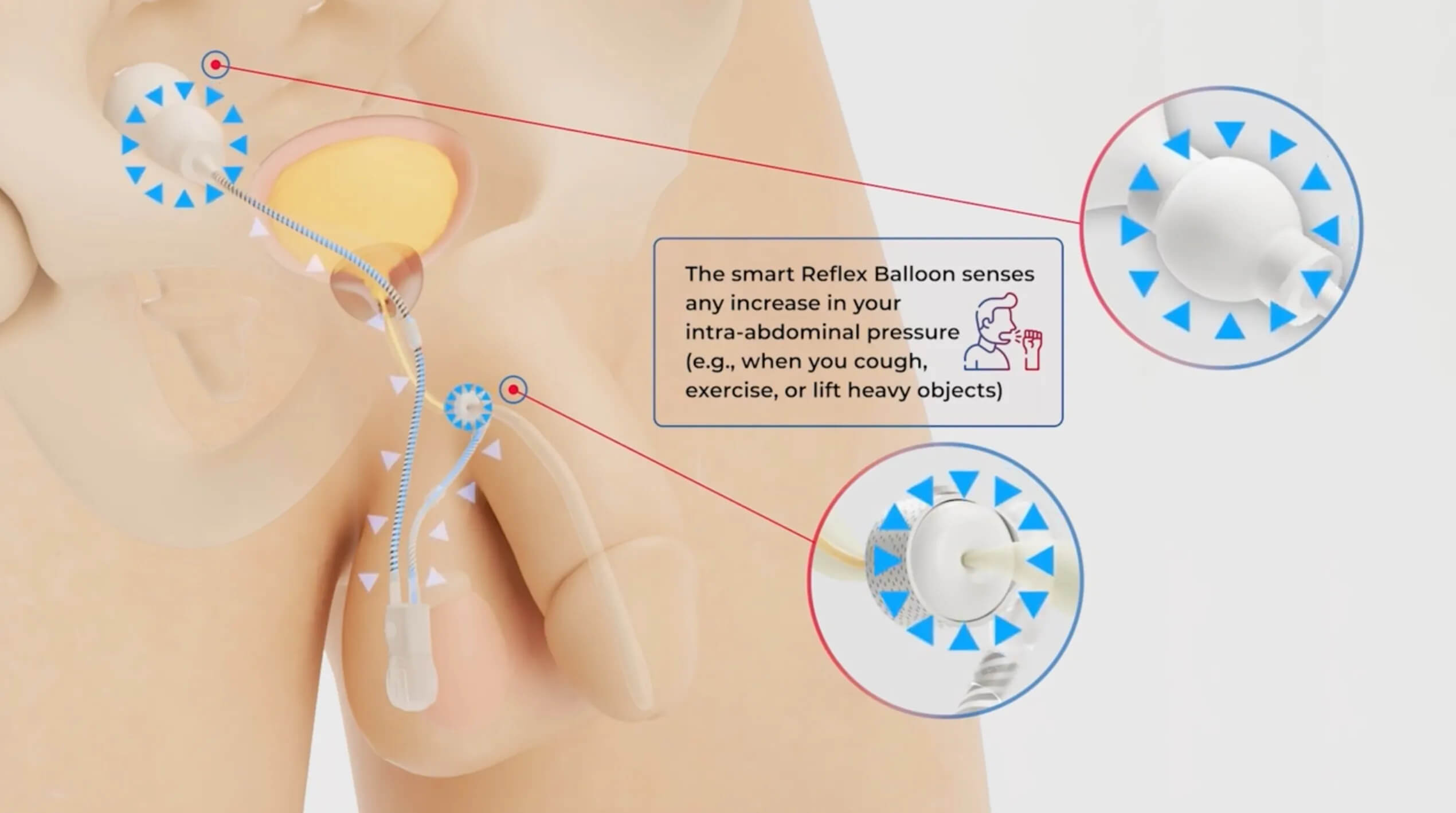 How to use your ContiReflex<sup>®</sup> Artificial Urinary Sphincter?