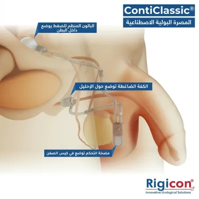 رسم توضيحي لمنتج المصرة البولية الاصطناعية ContiClassic
