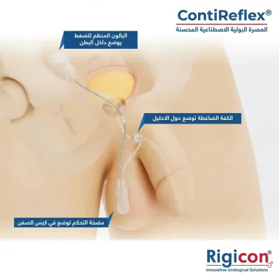 رسم توضيحي لمنتج المصرة البولية الاصطناعية المحسّنة ContiReflex